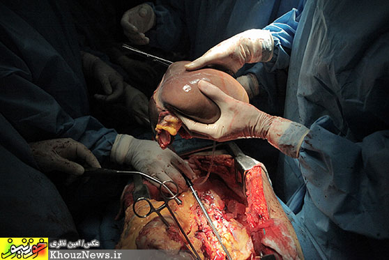 اهداء اعضاي بيمار مرگ مغزي در اهواز