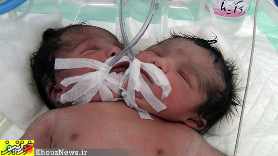 تولد نوزادی دو سر در دزفول