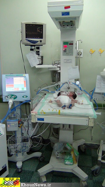 تولد نوزادی دو سر در دزفول