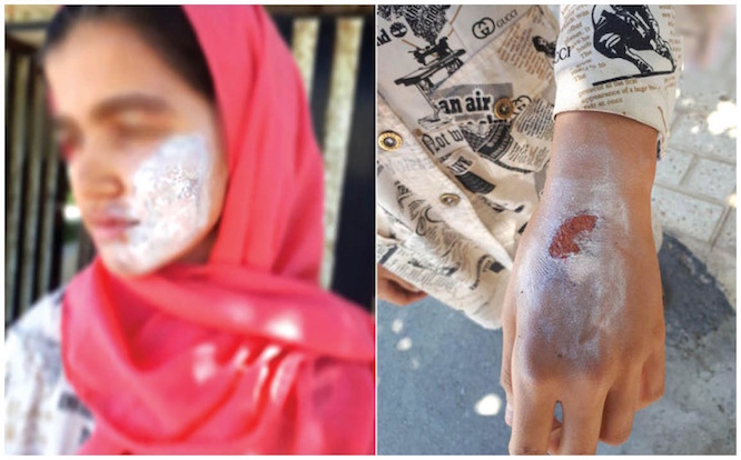 شکنجه نامادری با اتوی داغ بر تن دختر ۱۳ ساله
