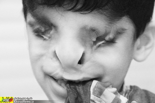 حامد پنج ساله، به دلیل داروهایی که مادرش نادانسته در دوران بارداری مصرف کرده از بدو تولد نابینا و دچار اختلالاتی در ناحیه فک، بینی و صورت بوده و هنوز به دلیل سوراخ بودن سقف دهان قادر به حرف زدن نمی باشد.